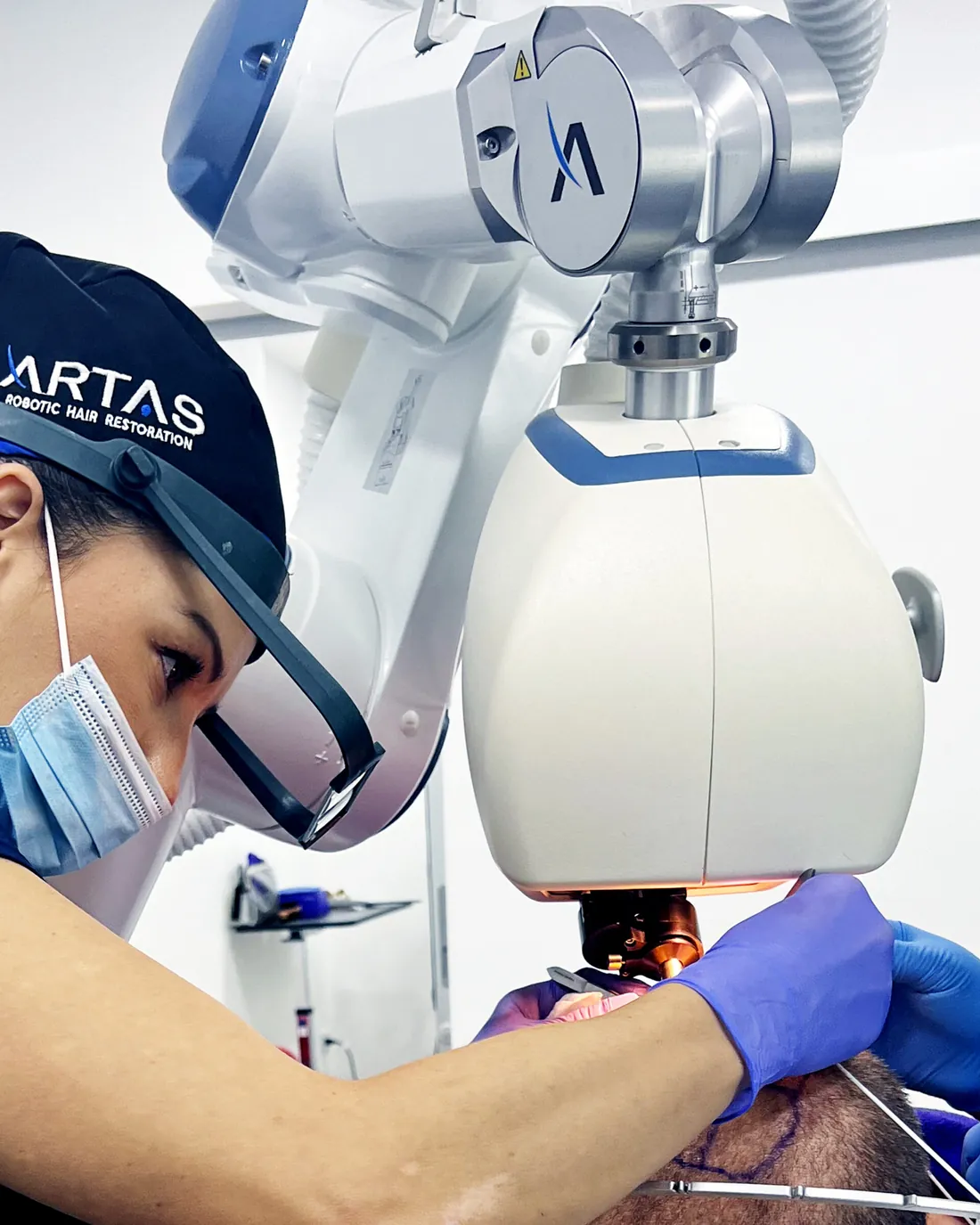ARTAS robot during a hair transplant at La Clínica del Pelo