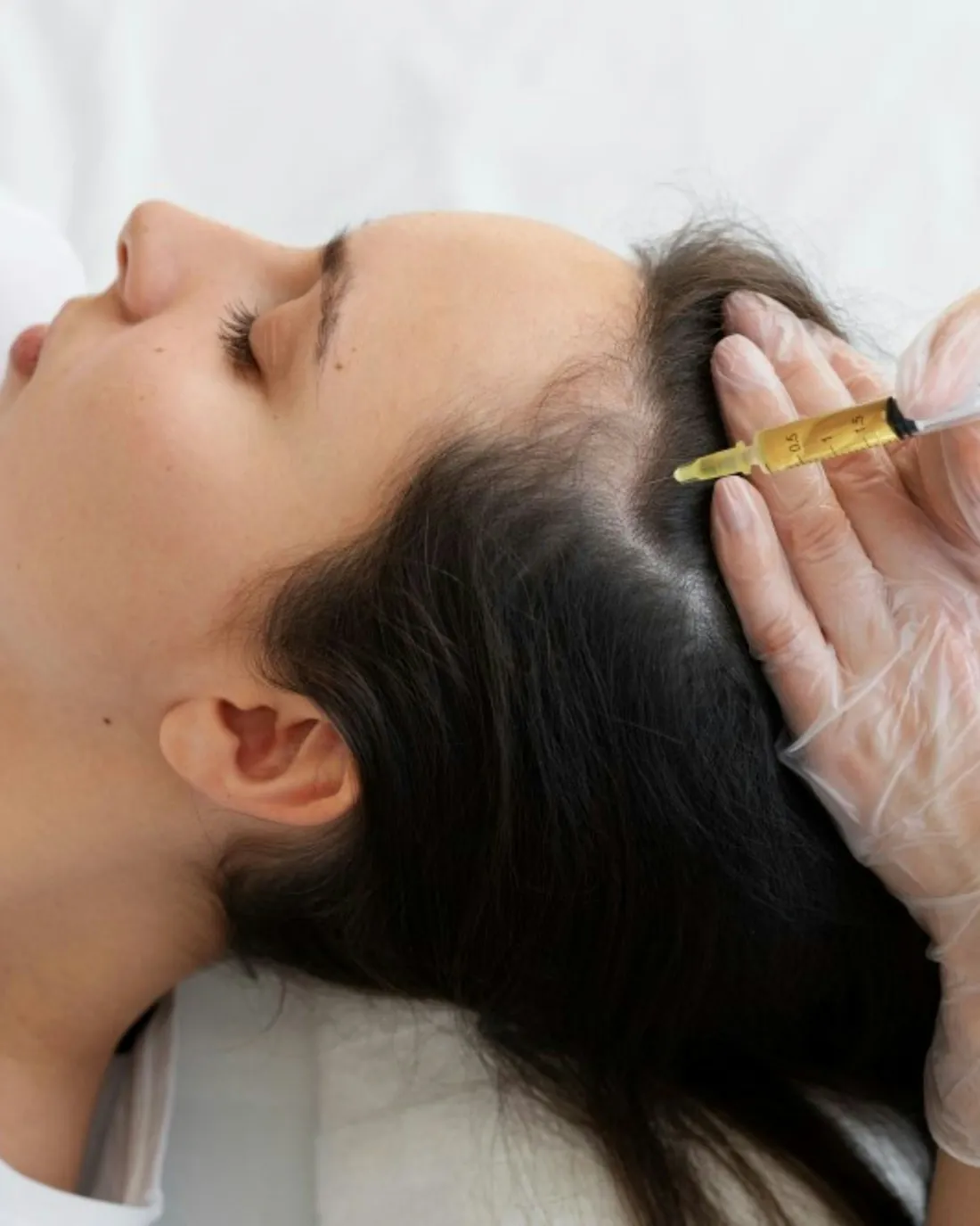 Hair mesotherapy applied to the scalp